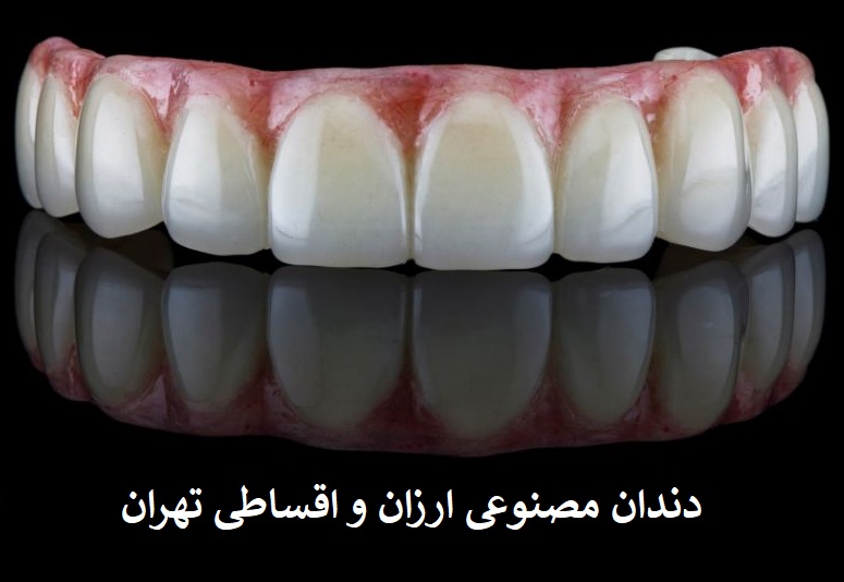 دندان مصنوعی ارزان و اقساطی تهران